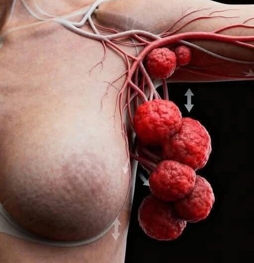 4 Señales Tempranas del Cáncer de Mama que Conviene Conocer