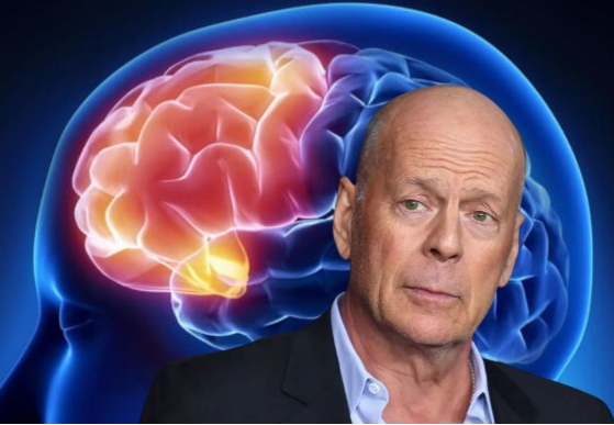 La enfermedad que cambio la vida de Bruce Willis
